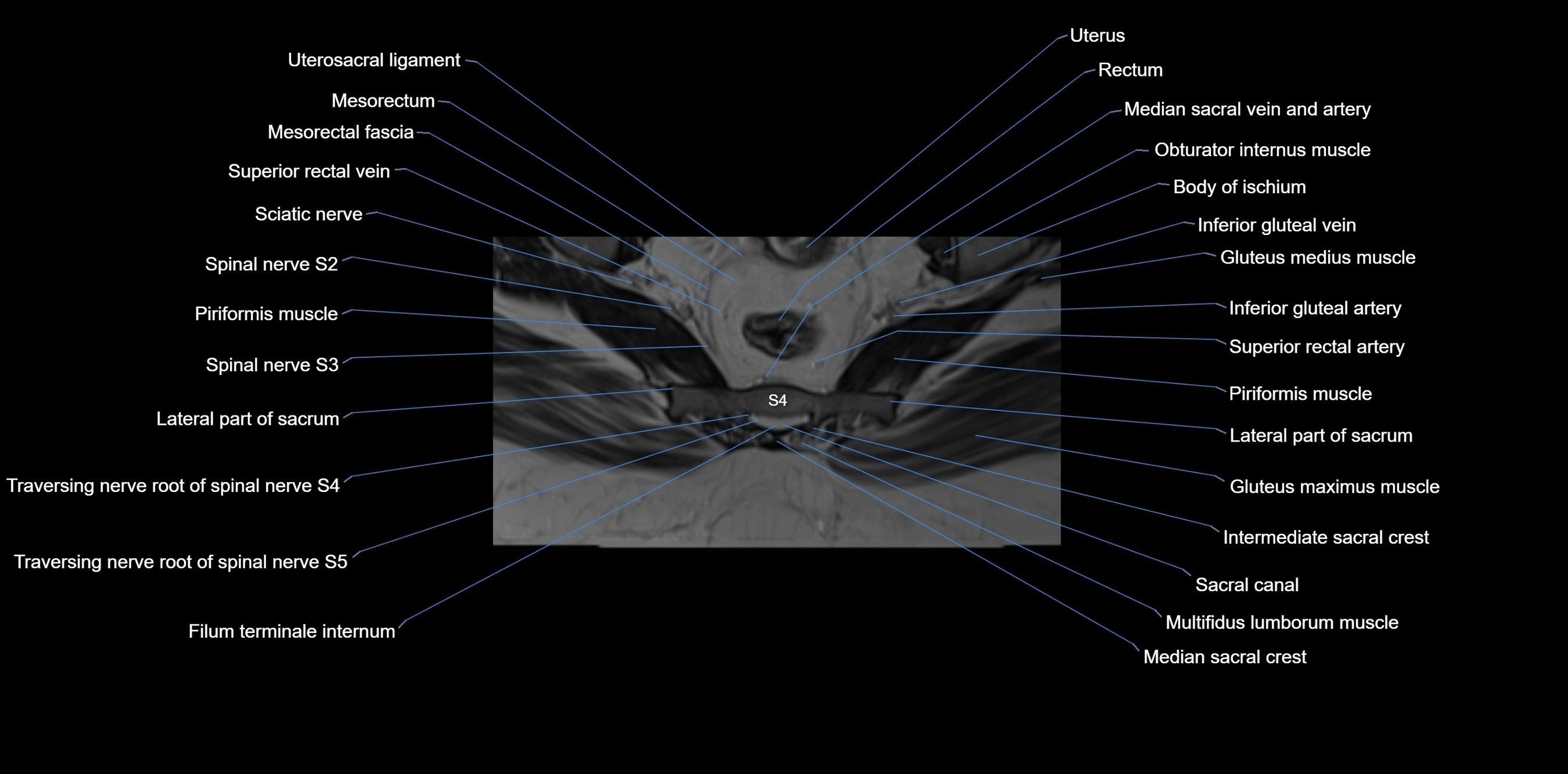 MRI sacrum, coccyx and sacroiliac joint axial cross sectional anatomy 3T  radiology  image-img-00001-00047.webp